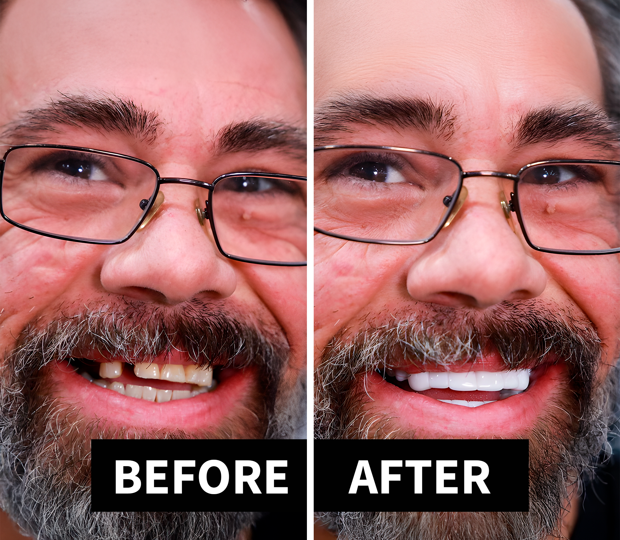 Shiny Smile Veneers Benefits
