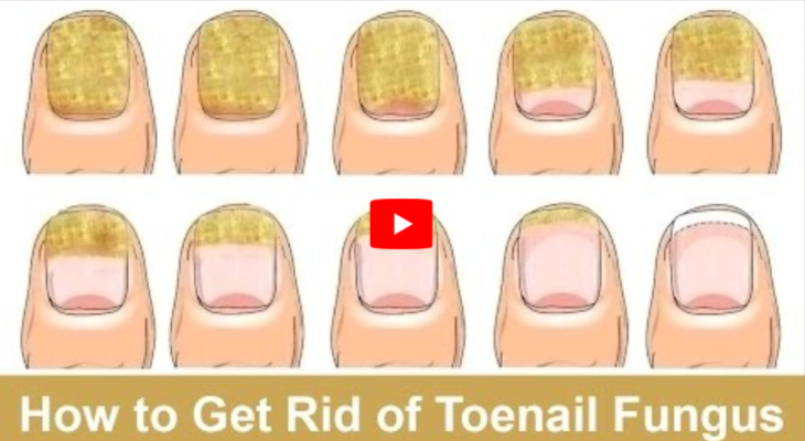 Clorox Pen for ToenailFungus