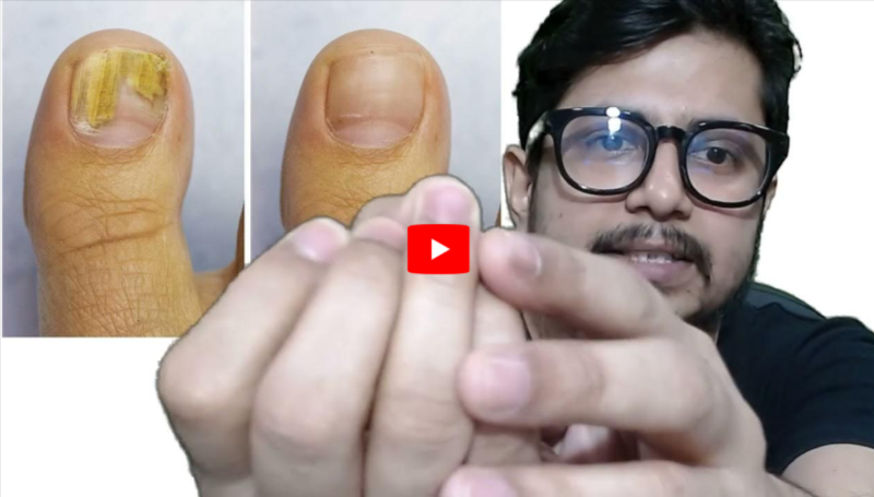 CloroxPen for Toenail Fungus