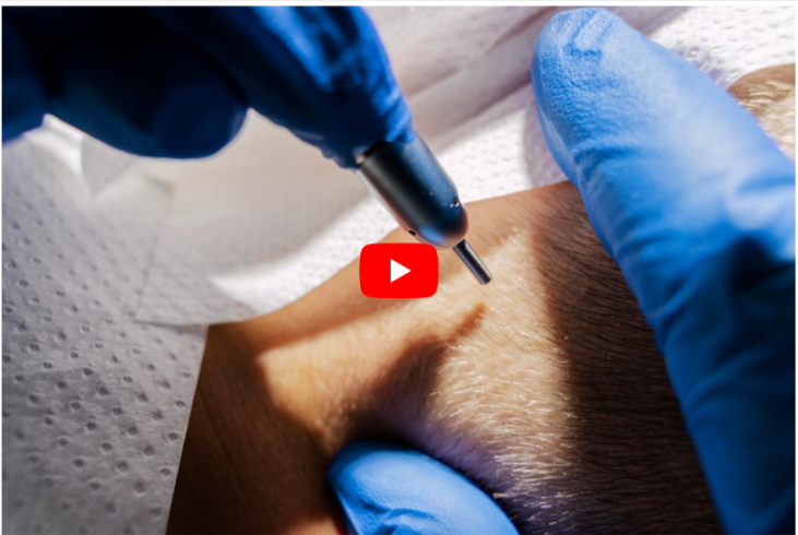 Laser Pen for Toenail Fungus