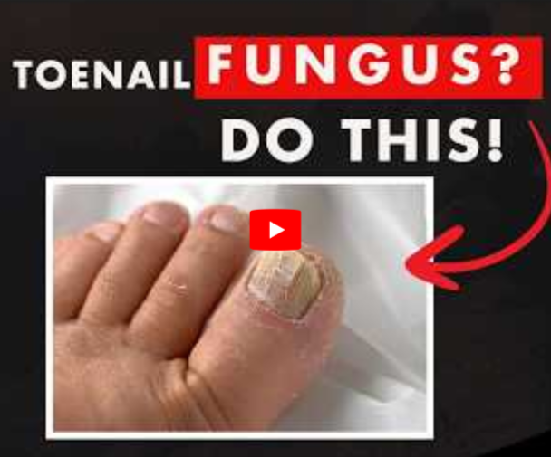 Toenail Fungus