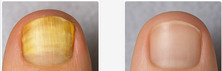 Orivelle Fungus Pen Benefits