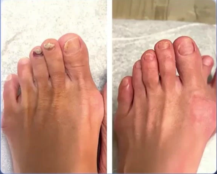 WellaNail Fungus Treatment Oil Benefits