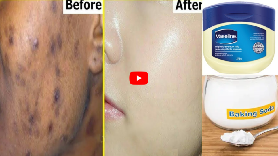 BakingSoda with Vaseline for Dark Spots