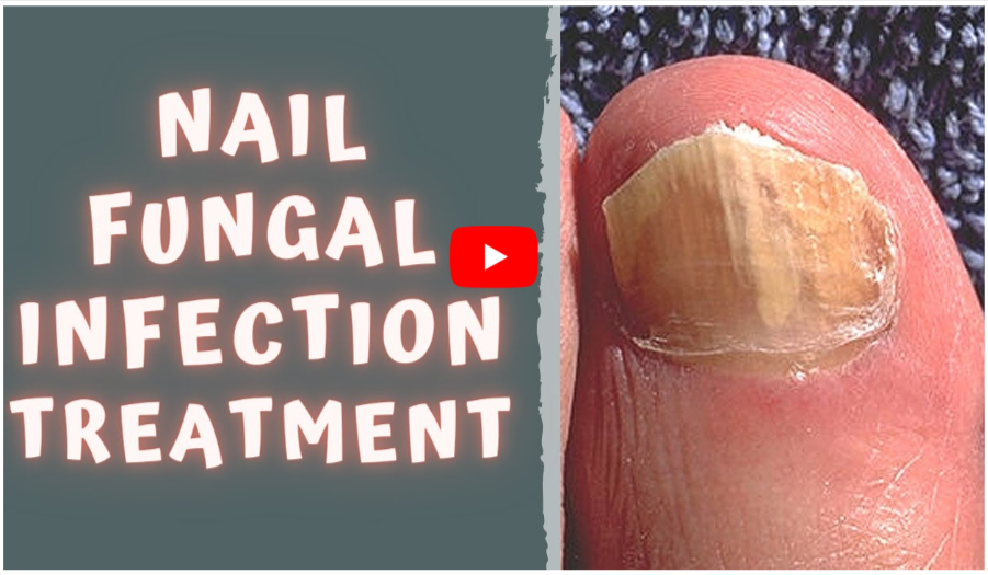 Ginger bread Nails Fungus