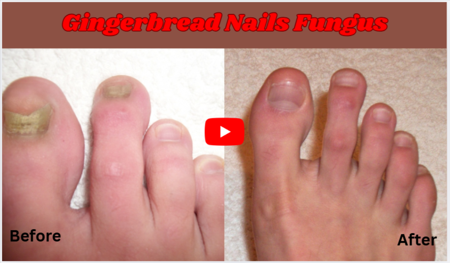 Gingerbread Nails Fungus