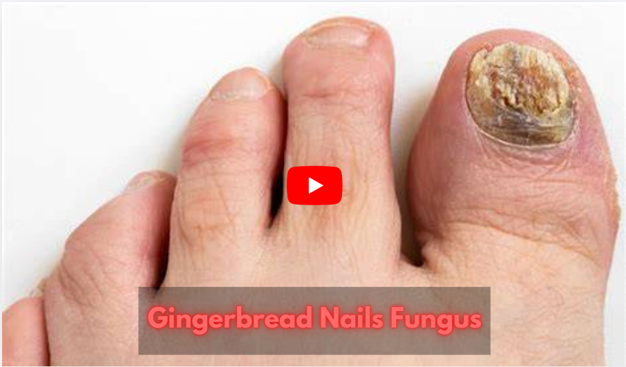 Gingerbread NailsFungus