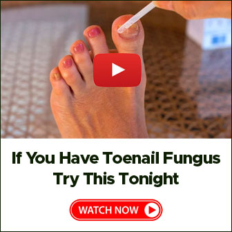 Toenail Fungus Try This Tonight