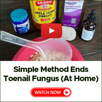 Simple Method Ends Toenail Fungus At Home