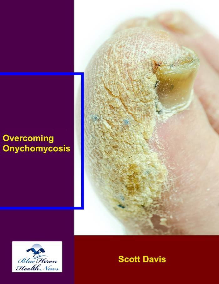 Overcoming Onychomycosis guide