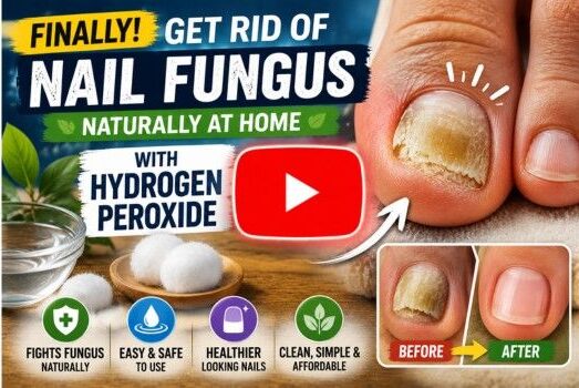 hydrogen peroxide for nail fungus