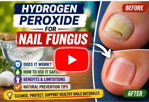 hydrogen peroxide for nail fungus